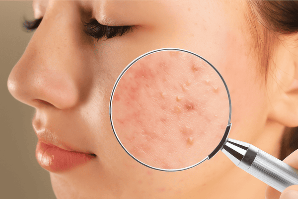 Biểu hiện của da dầu mụn